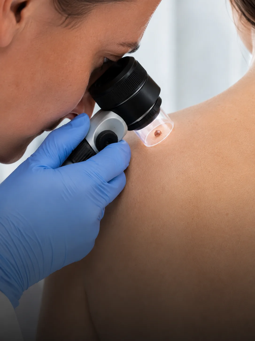 Dermatóloga observando un lunar a través del dermatoscopio